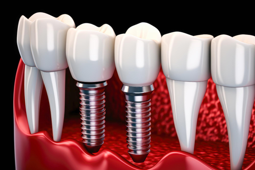 Multiple Tooth Implants in Turkey – Restoring Your Smile