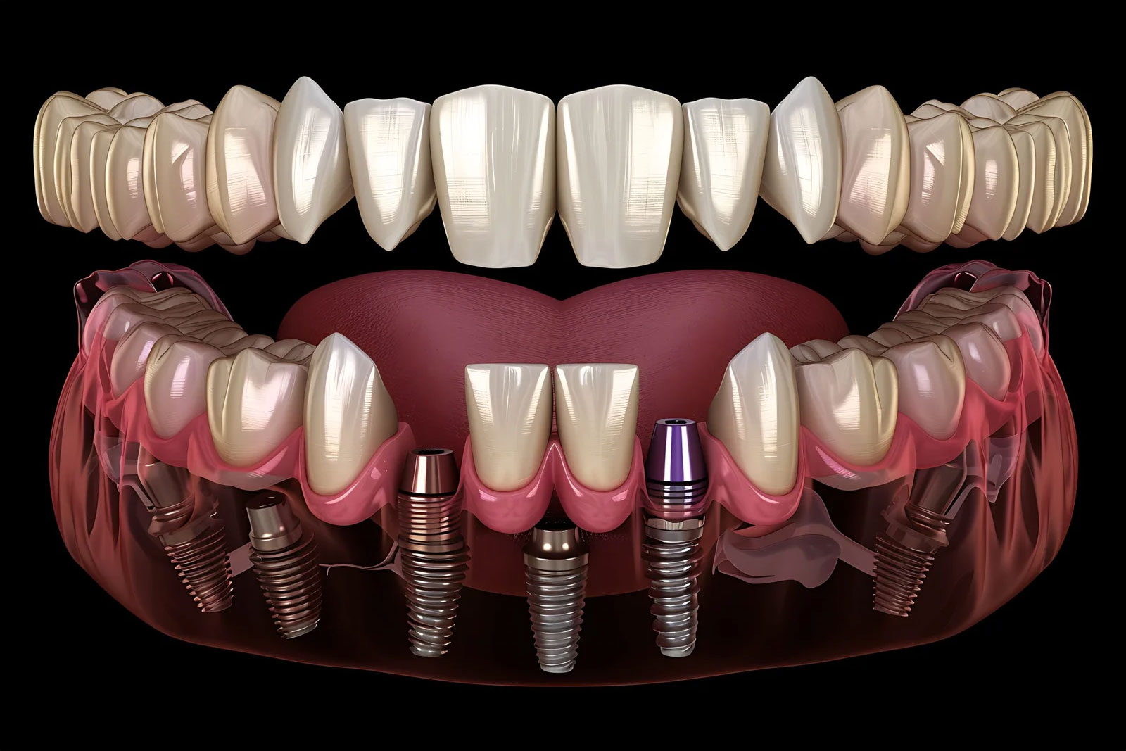 dental-implants-in-turkey