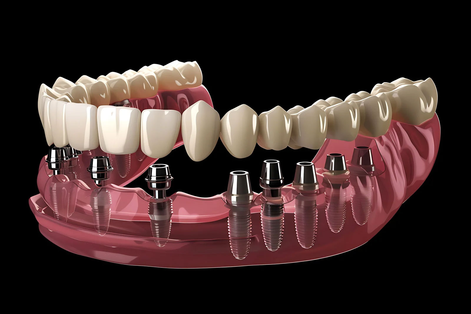 dental-implants-in-turkey2